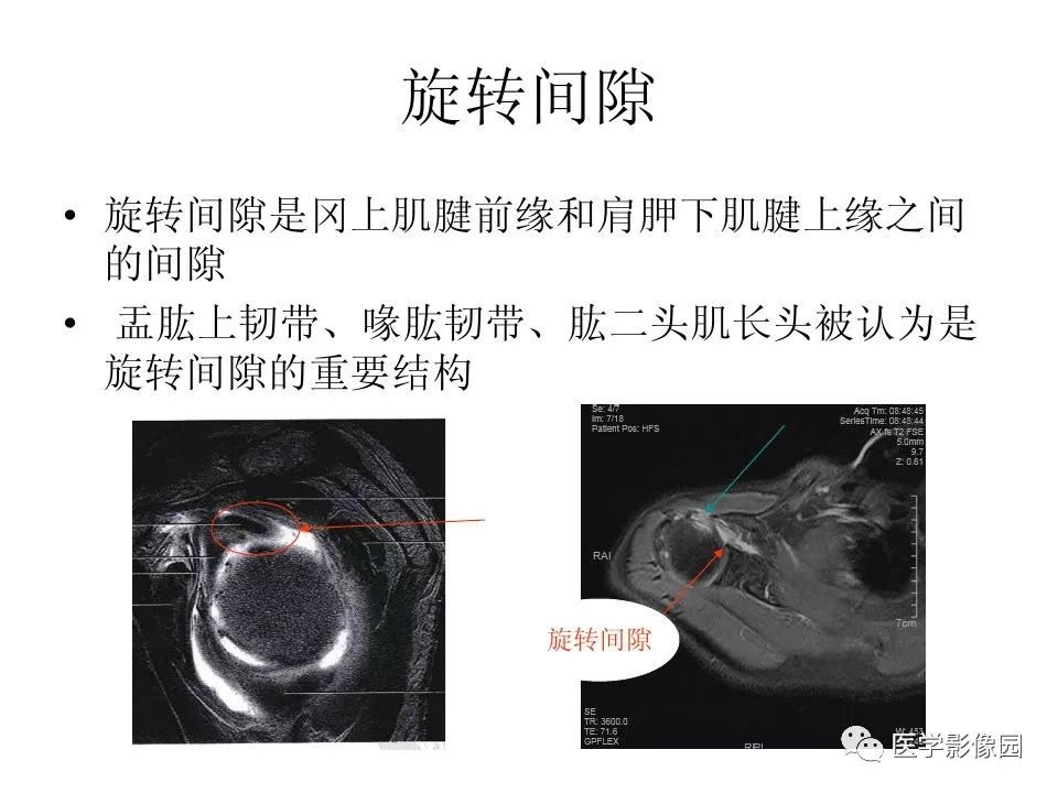 【PPT】肩关节韧带及损伤MR表现