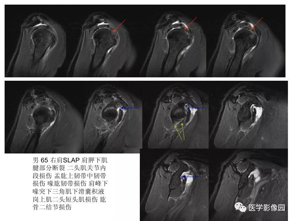 【PPT】肩关节韧带及损伤MR表现