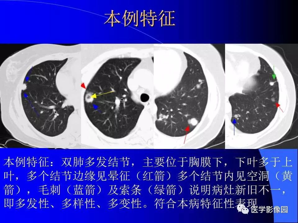 【病例】肺韦格纳肉芽肿1例CT影像表现