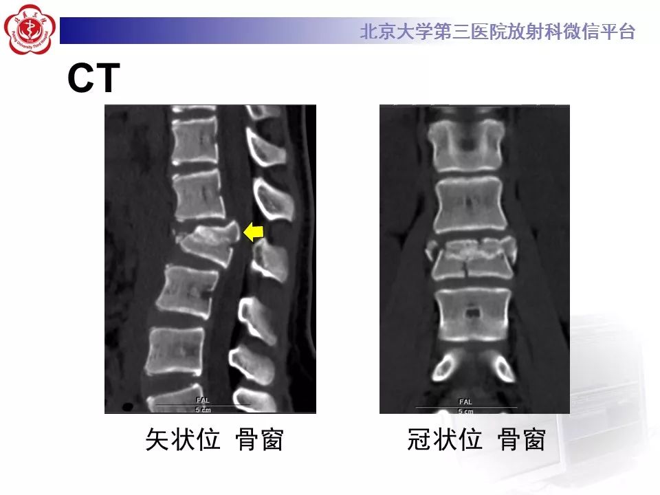 【PPT】脊柱创伤稳定性的评估—三柱理论