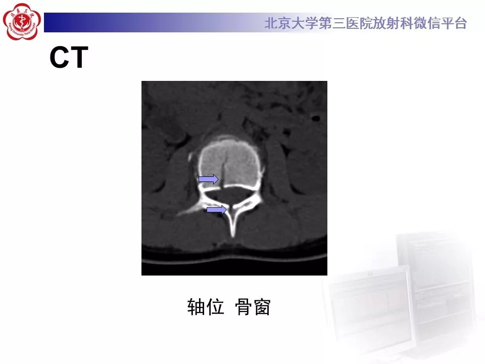 【PPT】脊柱创伤稳定性的评估—三柱理论
