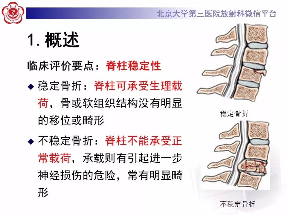 【PPT】脊柱创伤稳定性的评估—三柱理论