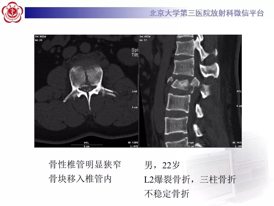 【PPT】脊柱创伤稳定性的评估—三柱理论