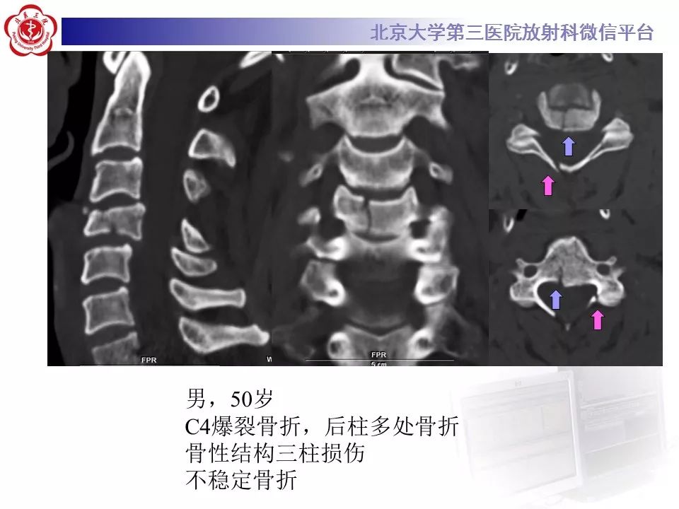 【PPT】脊柱创伤稳定性的评估—三柱理论