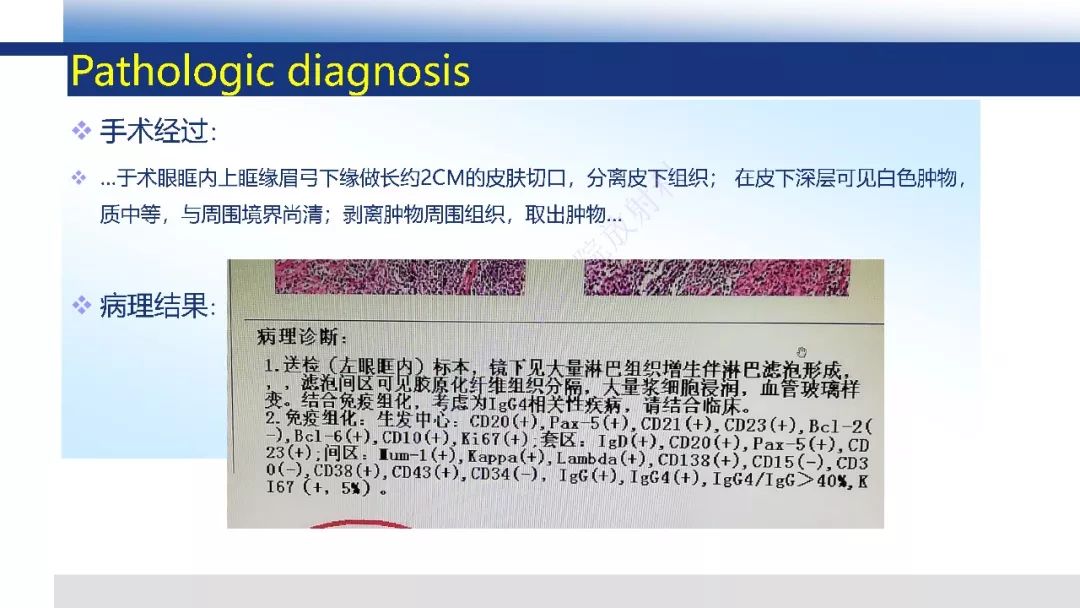 【PPT】IgG4相关性眼病影像诊断
