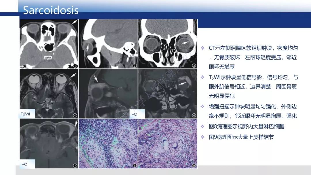 【PPT】IgG4相关性眼病影像诊断