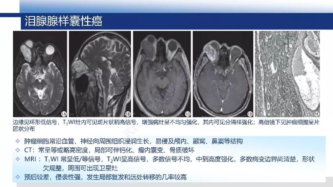 【PPT】IgG4相关性眼病影像诊断