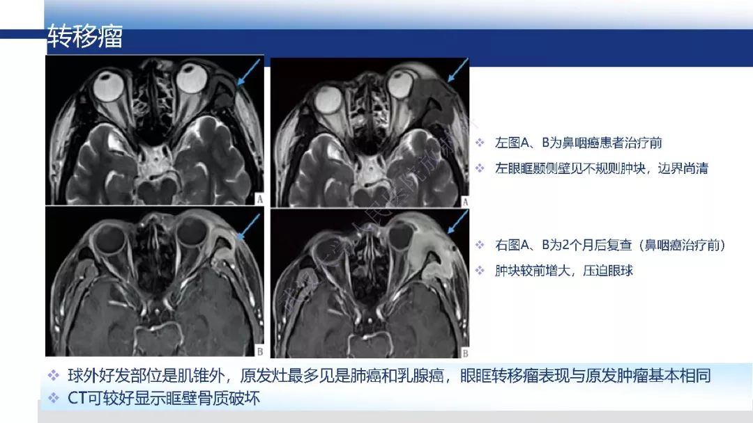 【PPT】IgG4相关性眼病影像诊断