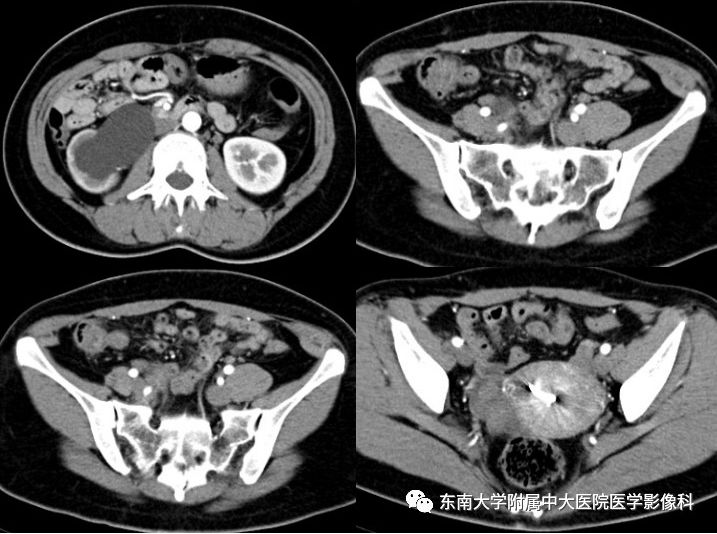 【病例】输尿管子宫内膜异位症1例CT