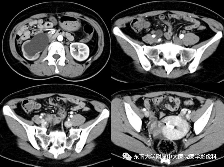 【病例】输尿管子宫内膜异位症1例CT
