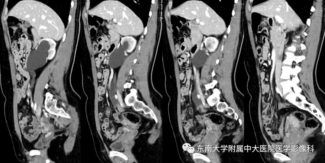 【病例】输尿管子宫内膜异位症1例CT