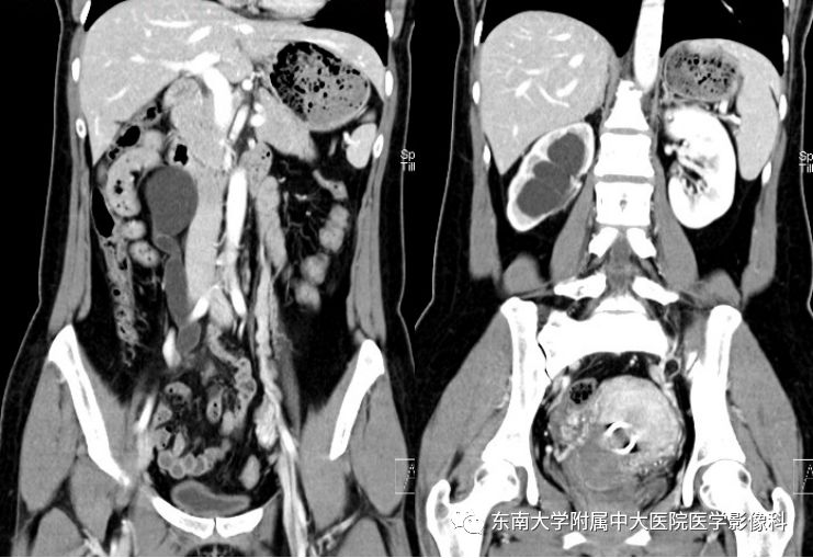 【病例】输尿管子宫内膜异位症1例CT