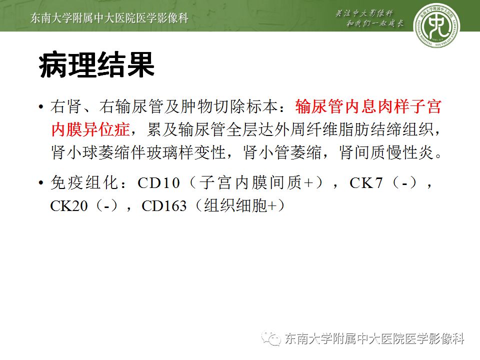 【病例】输尿管子宫内膜异位症1例CT