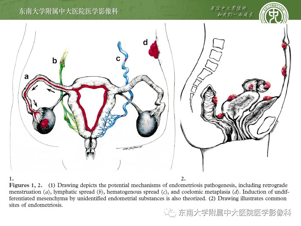 【病例】输尿管子宫内膜异位症1例CT