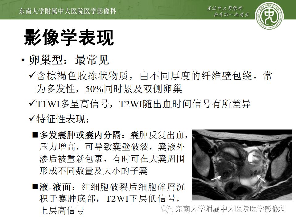 【病例】输尿管子宫内膜异位症1例CT
