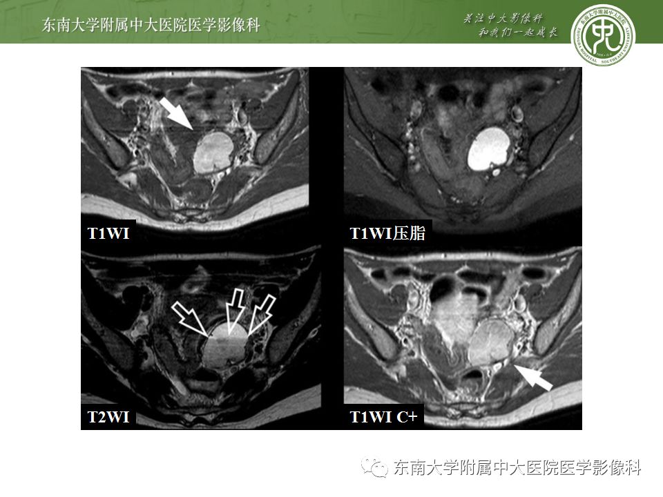 【病例】输尿管子宫内膜异位症1例CT