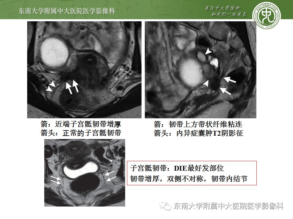【病例】输尿管子宫内膜异位症1例CT