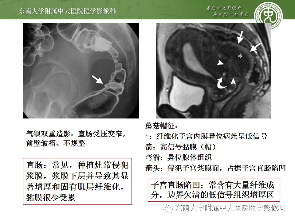 【病例】输尿管子宫内膜异位症1例CT