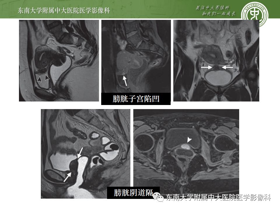 【病例】输尿管子宫内膜异位症1例CT