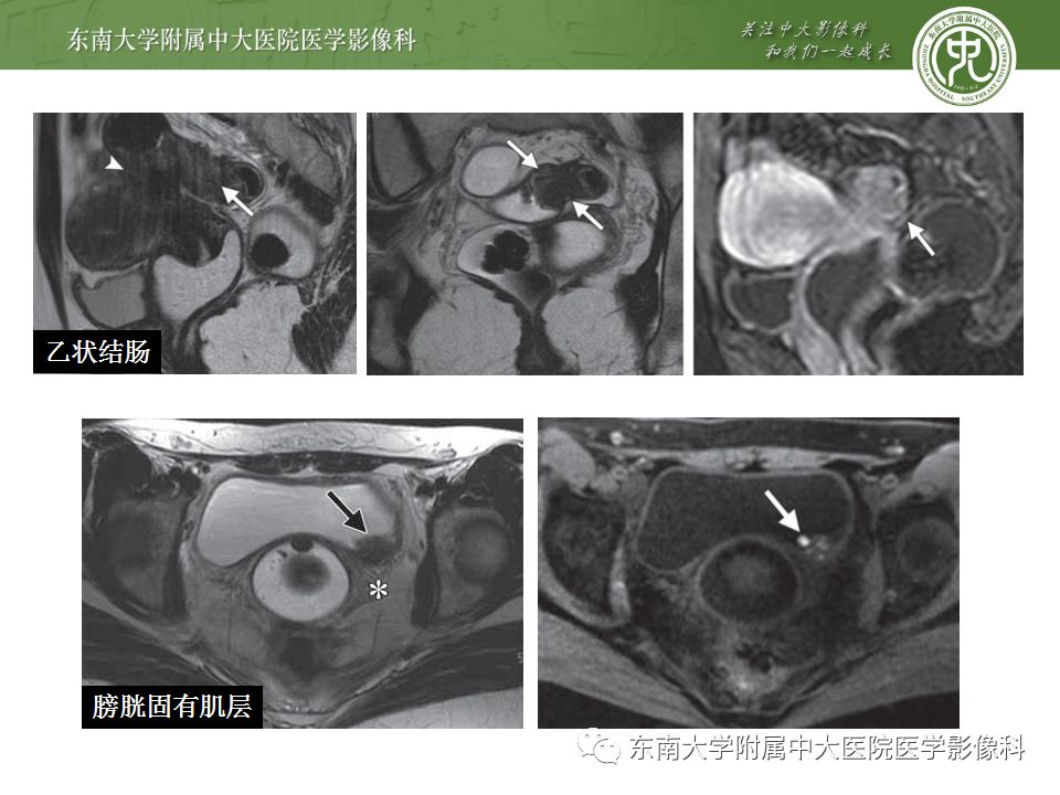 【病例】输尿管子宫内膜异位症1例CT