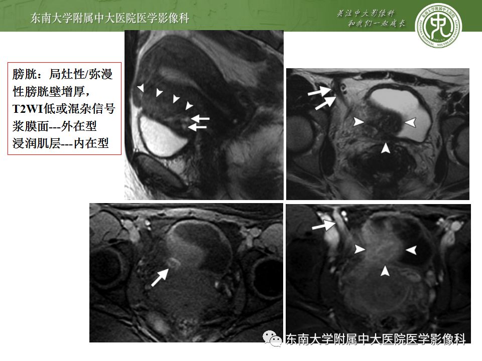 【病例】输尿管子宫内膜异位症1例CT