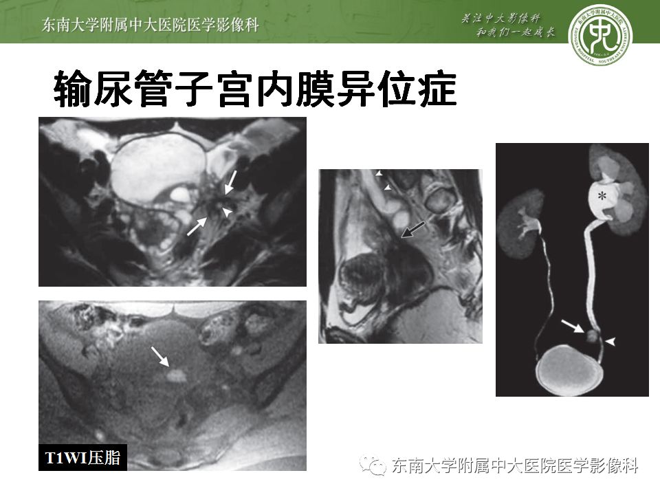 【病例】输尿管子宫内膜异位症1例CT