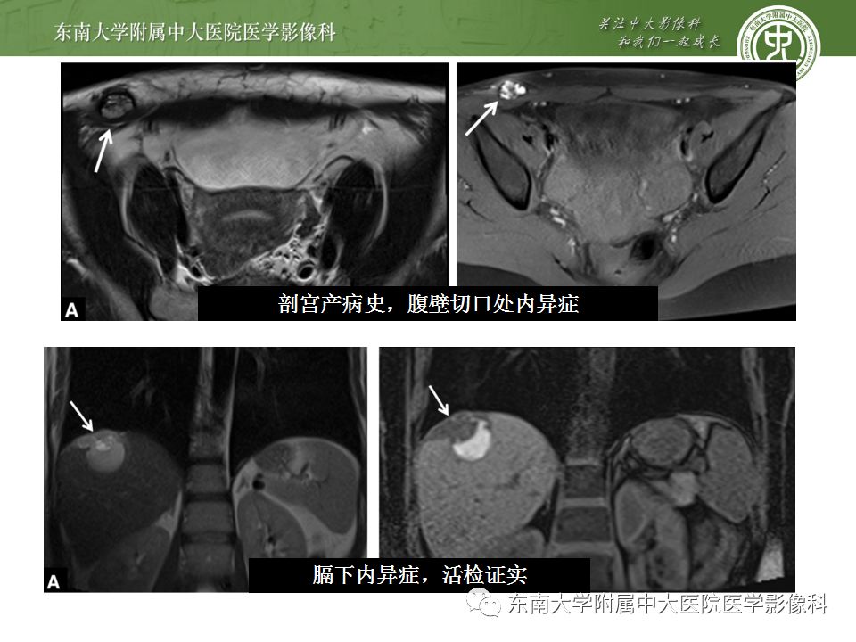 【病例】输尿管子宫内膜异位症1例CT
