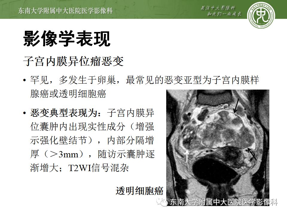 【病例】输尿管子宫内膜异位症1例CT