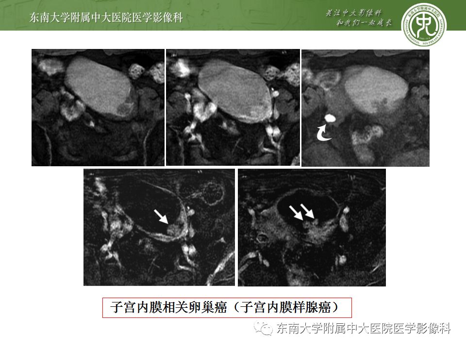 【病例】输尿管子宫内膜异位症1例CT
