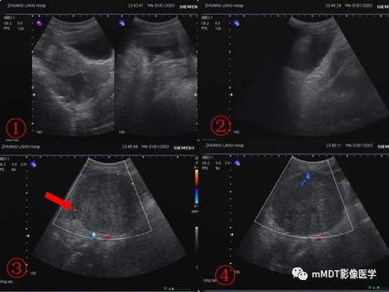 【病例】卵泡膜细胞瘤1例MR影像诊断思路分析 【病例】卵泡膜细胞瘤1例MR影像诊断思路分析