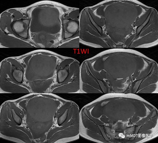 【病例】卵泡膜细胞瘤1例MR影像诊断思路分析 【病例】卵泡膜细胞瘤1例MR影像诊断思路分析