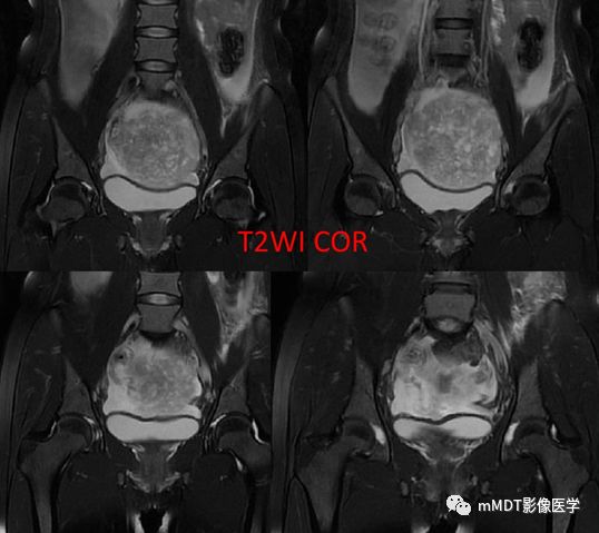 【病例】卵泡膜细胞瘤1例MR影像诊断思路分析 【病例】卵泡膜细胞瘤1例MR影像诊断思路分析
