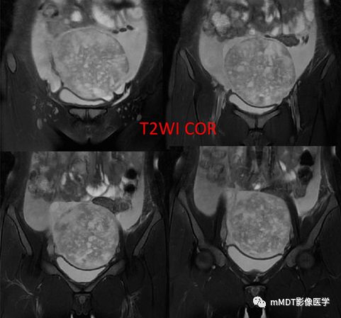 【病例】卵泡膜细胞瘤1例MR影像诊断思路分析 【病例】卵泡膜细胞瘤1例MR影像诊断思路分析