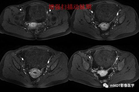 【病例】卵泡膜细胞瘤1例MR影像诊断思路分析 【病例】卵泡膜细胞瘤1例MR影像诊断思路分析