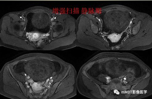 【病例】卵泡膜细胞瘤1例MR影像诊断思路分析 【病例】卵泡膜细胞瘤1例MR影像诊断思路分析