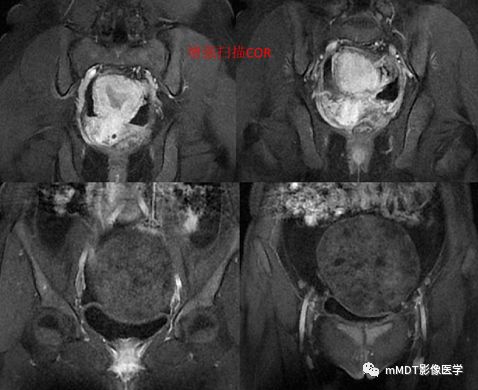 【病例】卵泡膜细胞瘤1例MR影像诊断思路分析 【病例】卵泡膜细胞瘤1例MR影像诊断思路分析