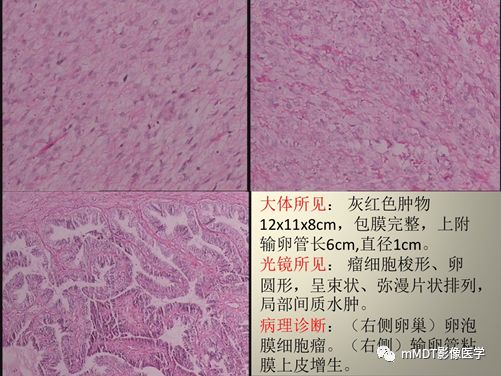 【病例】卵泡膜细胞瘤1例MR影像诊断思路分析 【病例】卵泡膜细胞瘤1例MR影像诊断思路分析