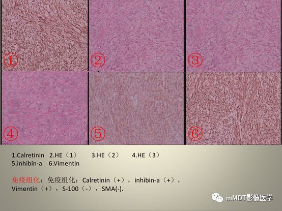 【病例】卵泡膜细胞瘤1例MR影像诊断思路分析 【病例】卵泡膜细胞瘤1例MR影像诊断思路分析