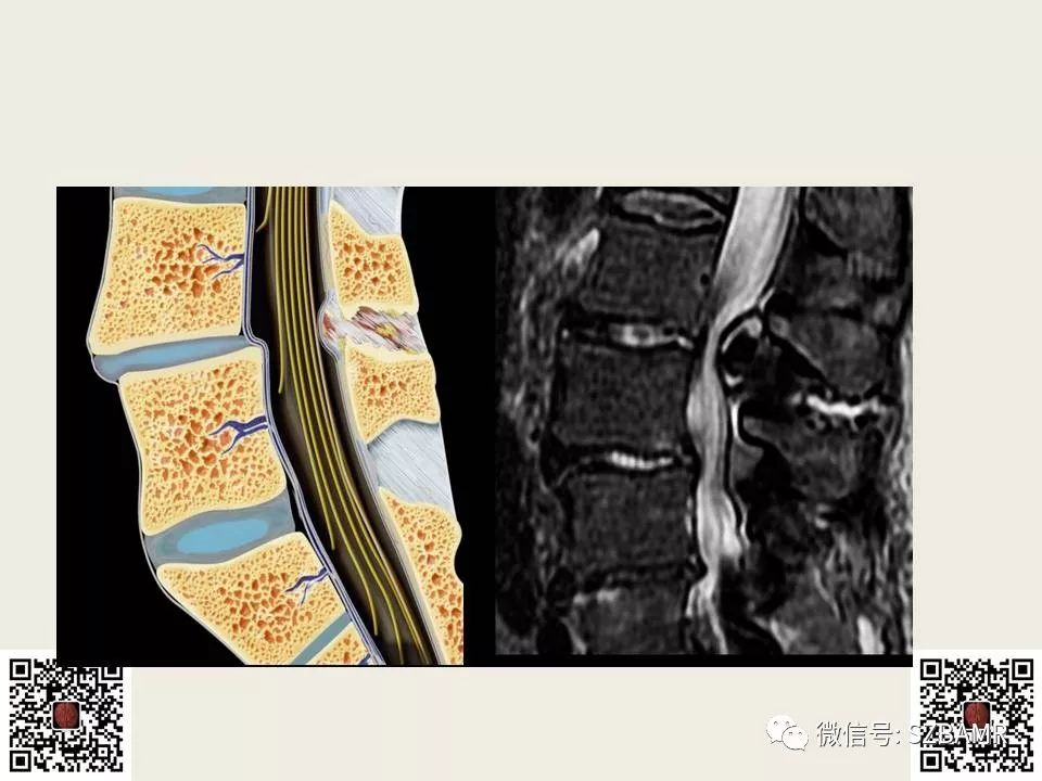 【PPT】巴斯特鲁普病+舒尔曼病