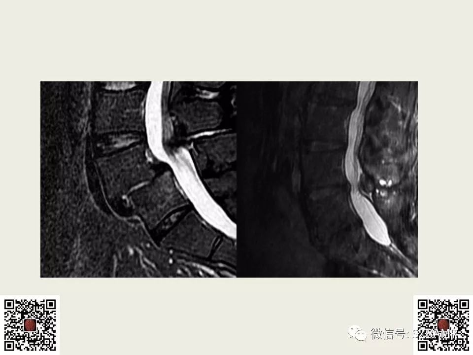 【PPT】巴斯特鲁普病+舒尔曼病