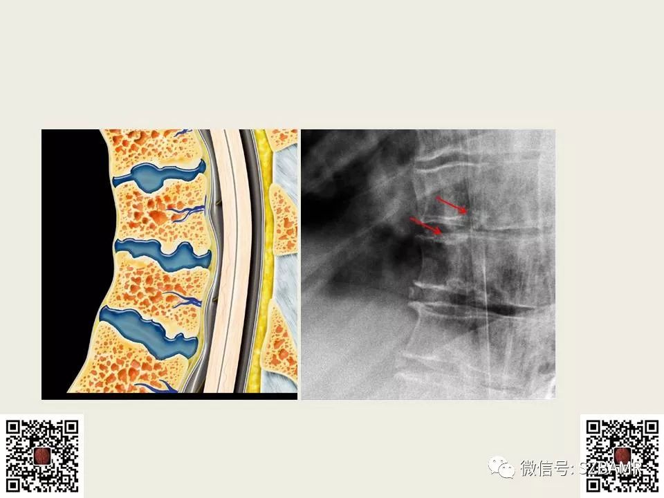 【PPT】巴斯特鲁普病+舒尔曼病