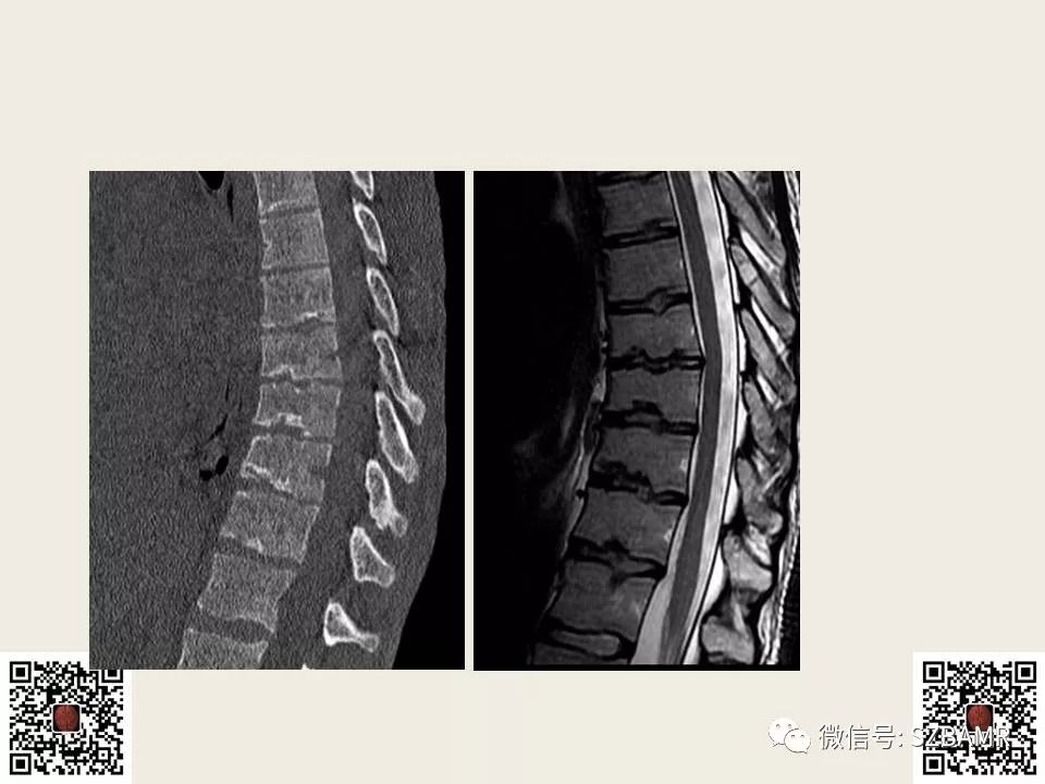 【PPT】巴斯特鲁普病+舒尔曼病
