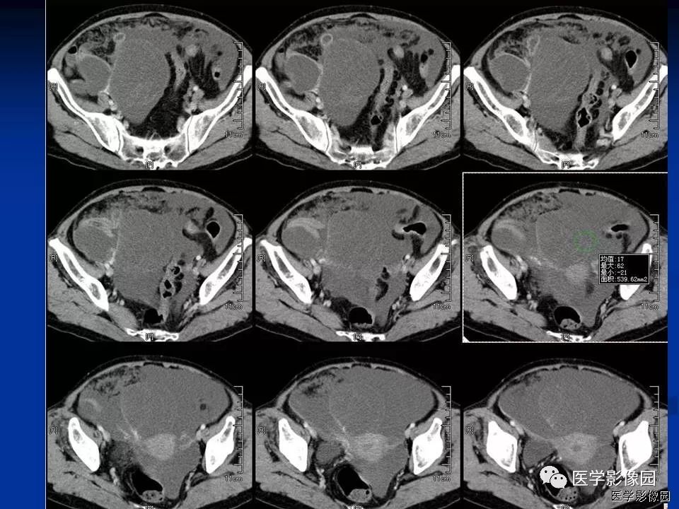 【病例】卵巢低度恶性黏液性囊腺癌1例CT 【病例】卵巢低度恶性黏液性囊腺癌1例CT