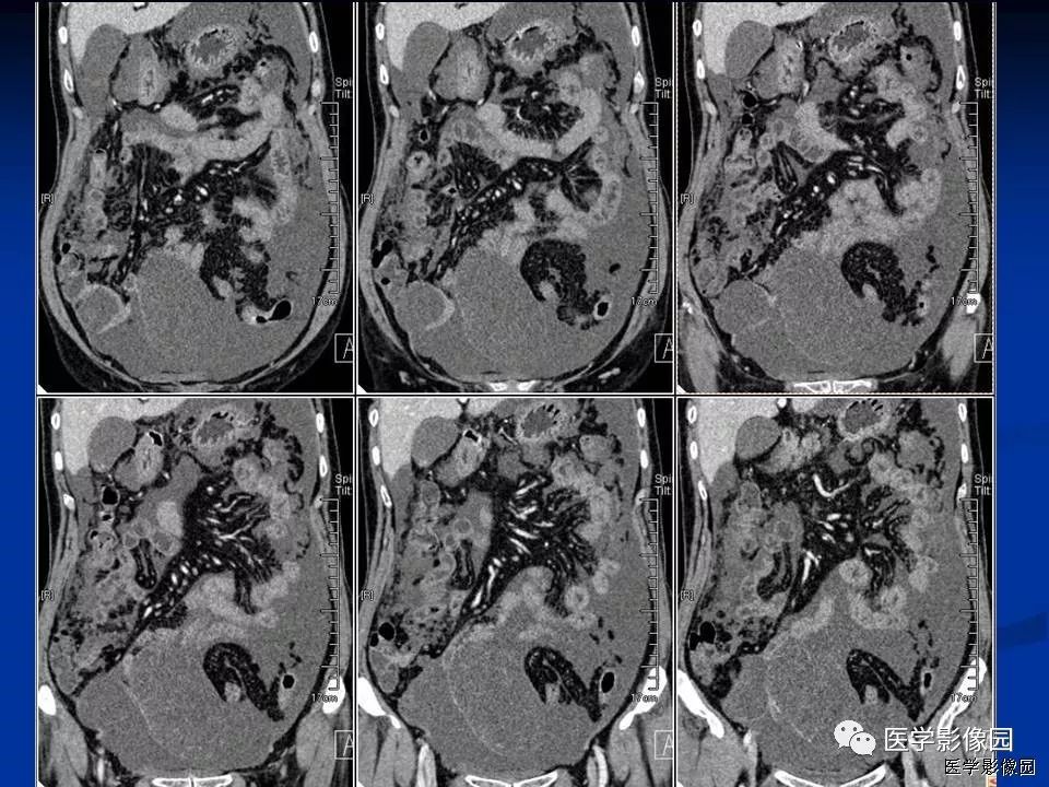 【病例】卵巢低度恶性黏液性囊腺癌1例CT 【病例】卵巢低度恶性黏液性囊腺癌1例CT