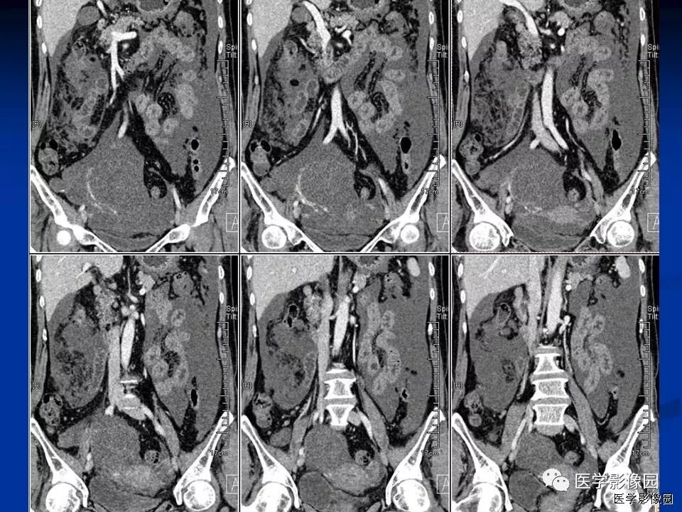 【病例】卵巢低度恶性黏液性囊腺癌1例CT 【病例】卵巢低度恶性黏液性囊腺癌1例CT