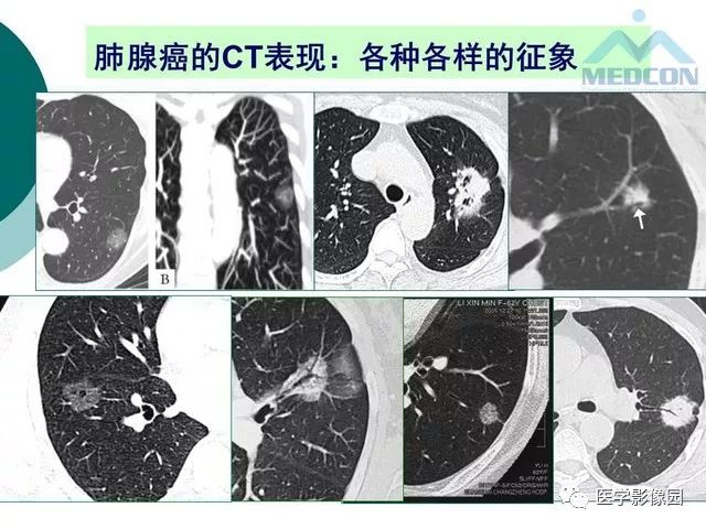 【PPT】囊性肺癌与肺癌伴空腔的CT征象诊断探讨