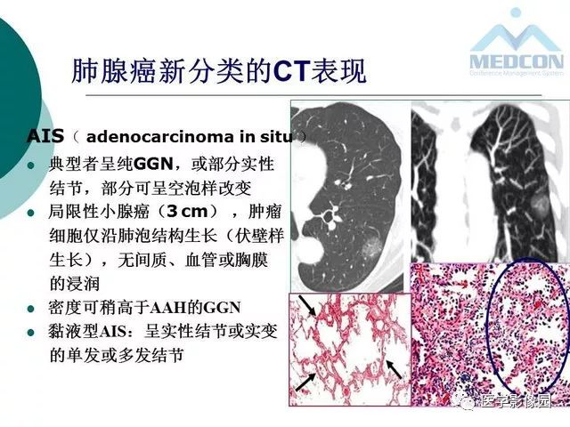 【PPT】囊性肺癌与肺癌伴空腔的CT征象诊断探讨