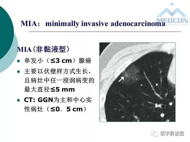 【PPT】囊性肺癌与肺癌伴空腔的CT征象诊断探讨