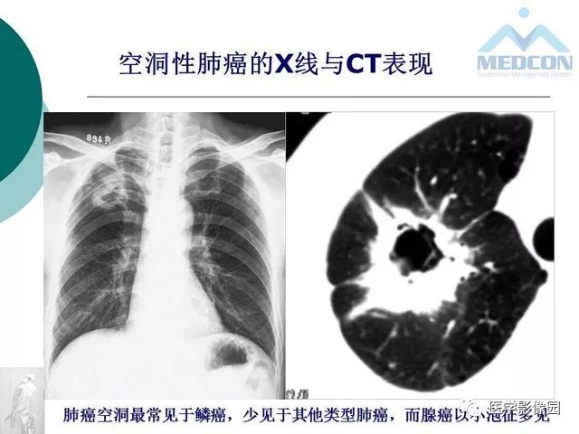 【PPT】囊性肺癌与肺癌伴空腔的CT征象诊断探讨
