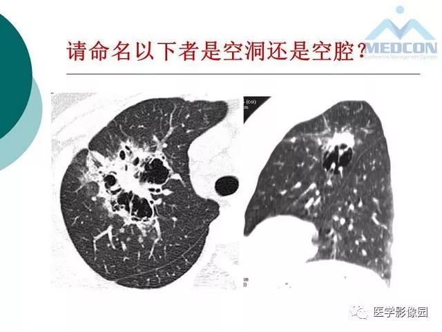 【PPT】囊性肺癌与肺癌伴空腔的CT征象诊断探讨